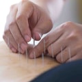 Understanding Acupuncture for Managing CVS Symptoms