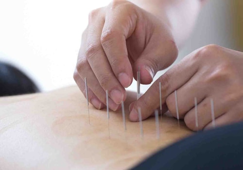 Understanding Acupuncture for Managing CVS Symptoms